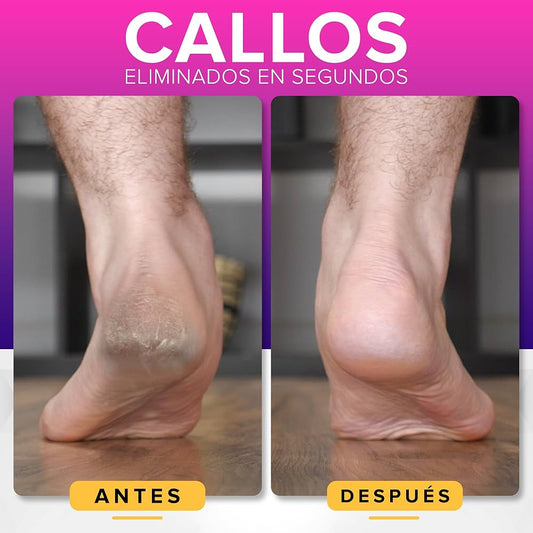 PIES SUAVES EN SEGUNDOS - con la lima - Footwell™
